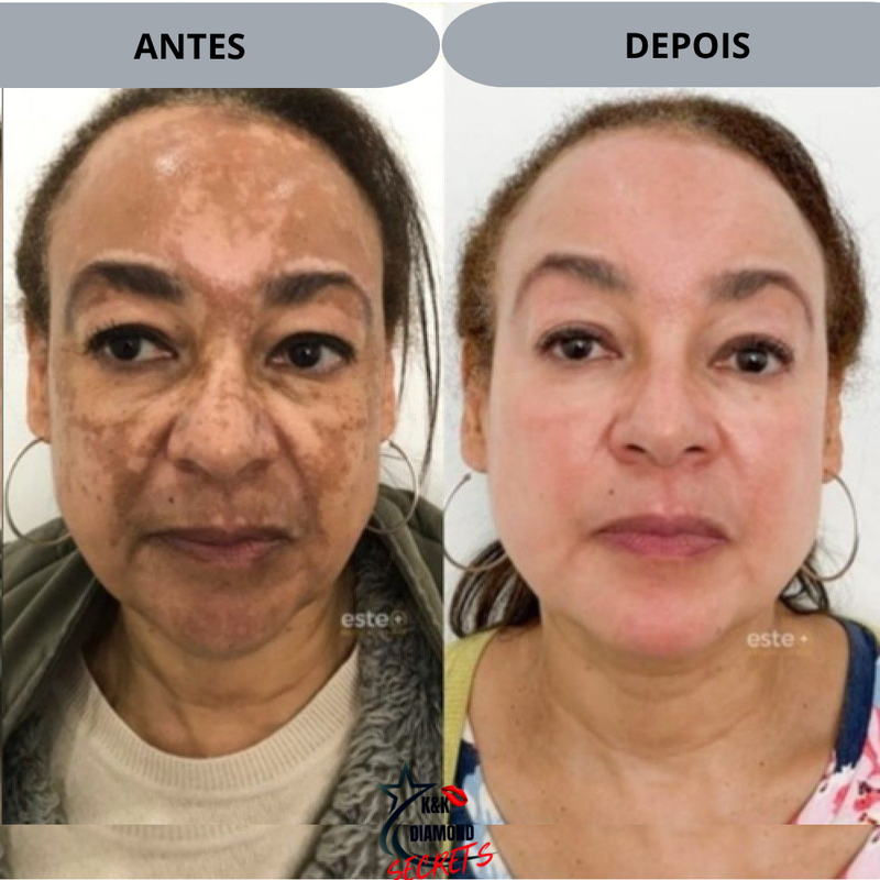 577-Spray Remove manchas de SOL, IDADE, GRAVIDA E MELASMA! 50% DE DESCONTO + FRETE GRÁTIS!