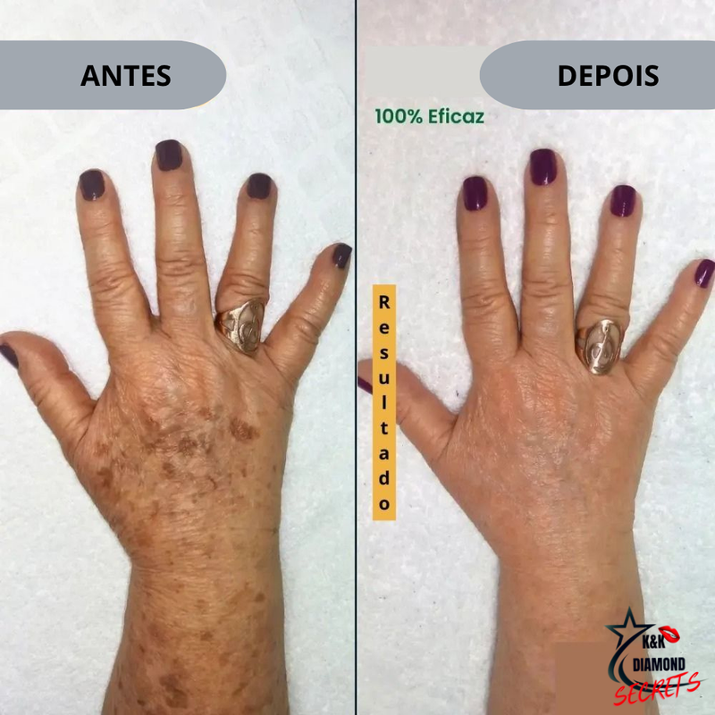 577-Spray Remove manchas de SOL, IDADE, GRAVIDA E MELASMA! 50% DE DESCONTO + FRETE GRÁTIS!