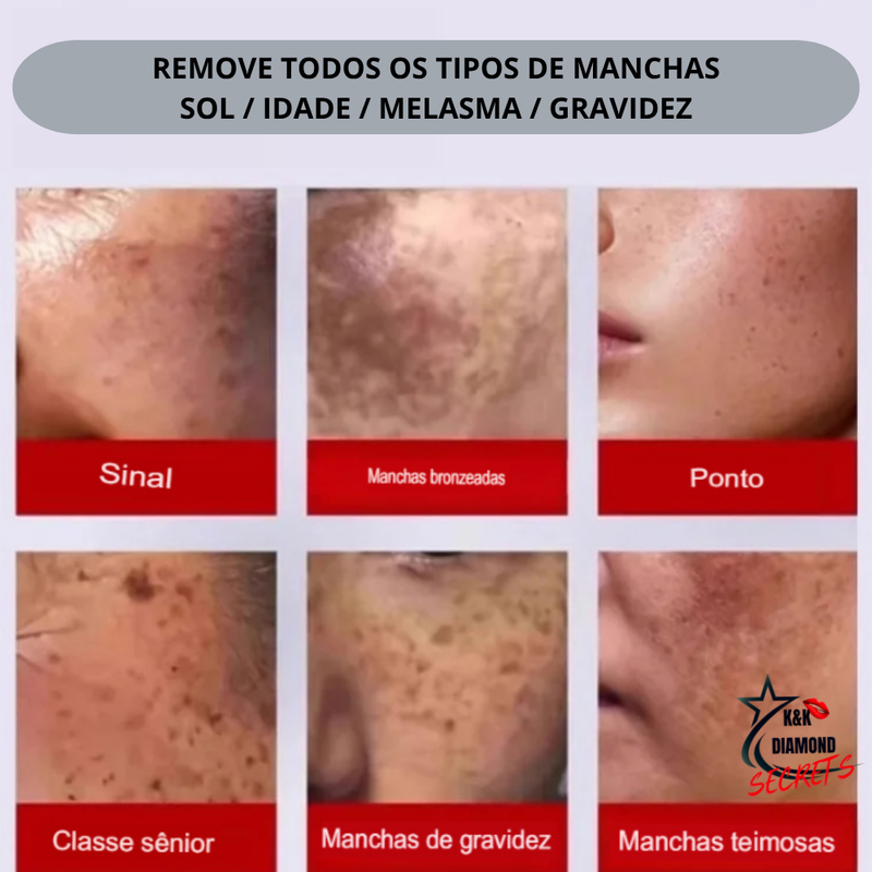 577-Spray Remove manchas de SOL, IDADE, GRAVIDA E MELASMA! 50% DE DESCONTO + FRETE GRÁTIS!