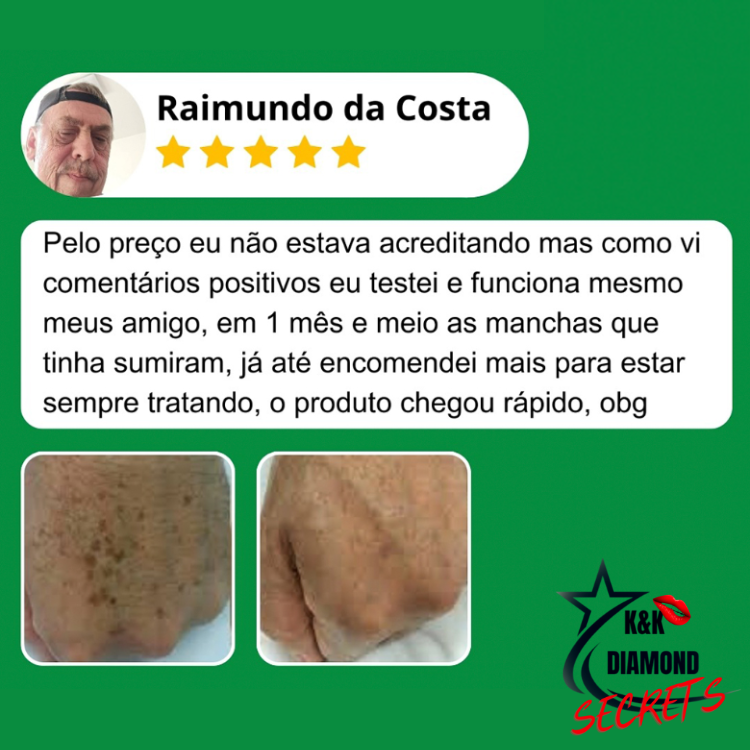 Clareador Spray Premium 577 – Elimine Manchas e Rejuvenesça Sua Pele _ Mais de 50% OFF + Frete Grátis !