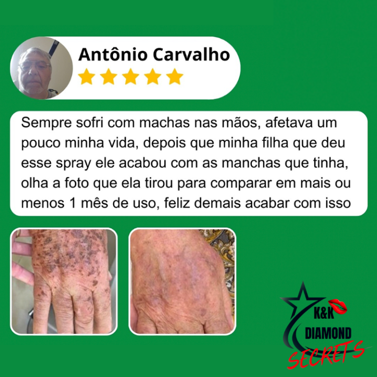 Clareador Spray Premium 577 – Elimine Manchas e Rejuvenesça Sua Pele _ Mais de 50% OFF + Frete Grátis !