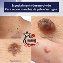 Removedor de Verrugas e manchas CEOERTY BLEMISG - 50% DE DESCONTO + FRETE GRÁTIS!