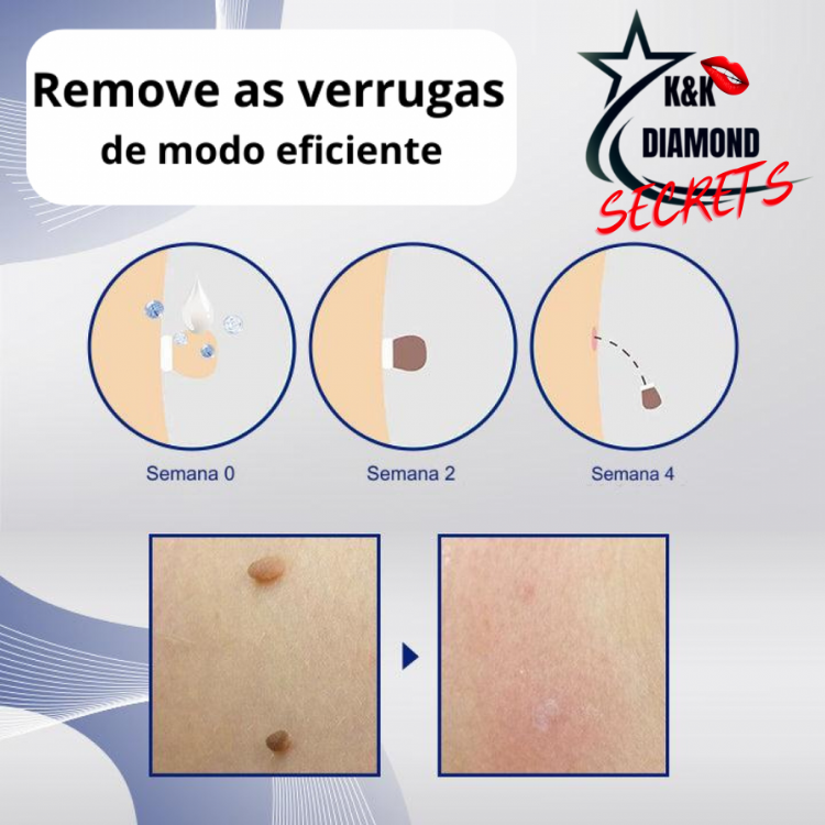 Removedor de Verrugas e manchas CEOERTY BLEMISG - 50% DE DESCONTO + FRETE GRÁTIS!