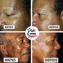 Removedor de Verrugas e manchas CEOERTY BLEMISG - 50% DE DESCONTO + FRETE GRÁTIS!