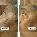 Removedor de Verrugas e manchas CEOERTY BLEMISG - 50% DE DESCONTO + FRETE GRÁTIS!